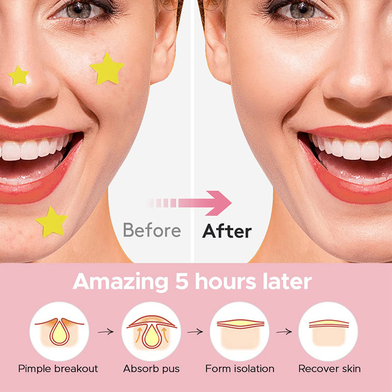 600Pcs/set Star Pimple Patch A - огляд і ціна Beauty With Makeup